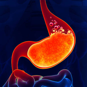 acid reflux or GERD