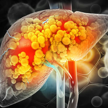 cirrhosis of the liver