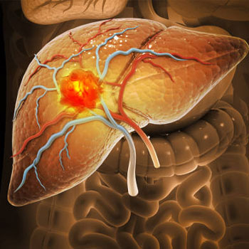 jaundice affected liver