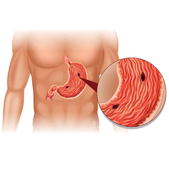 peptic ulcer or stomach ulcers